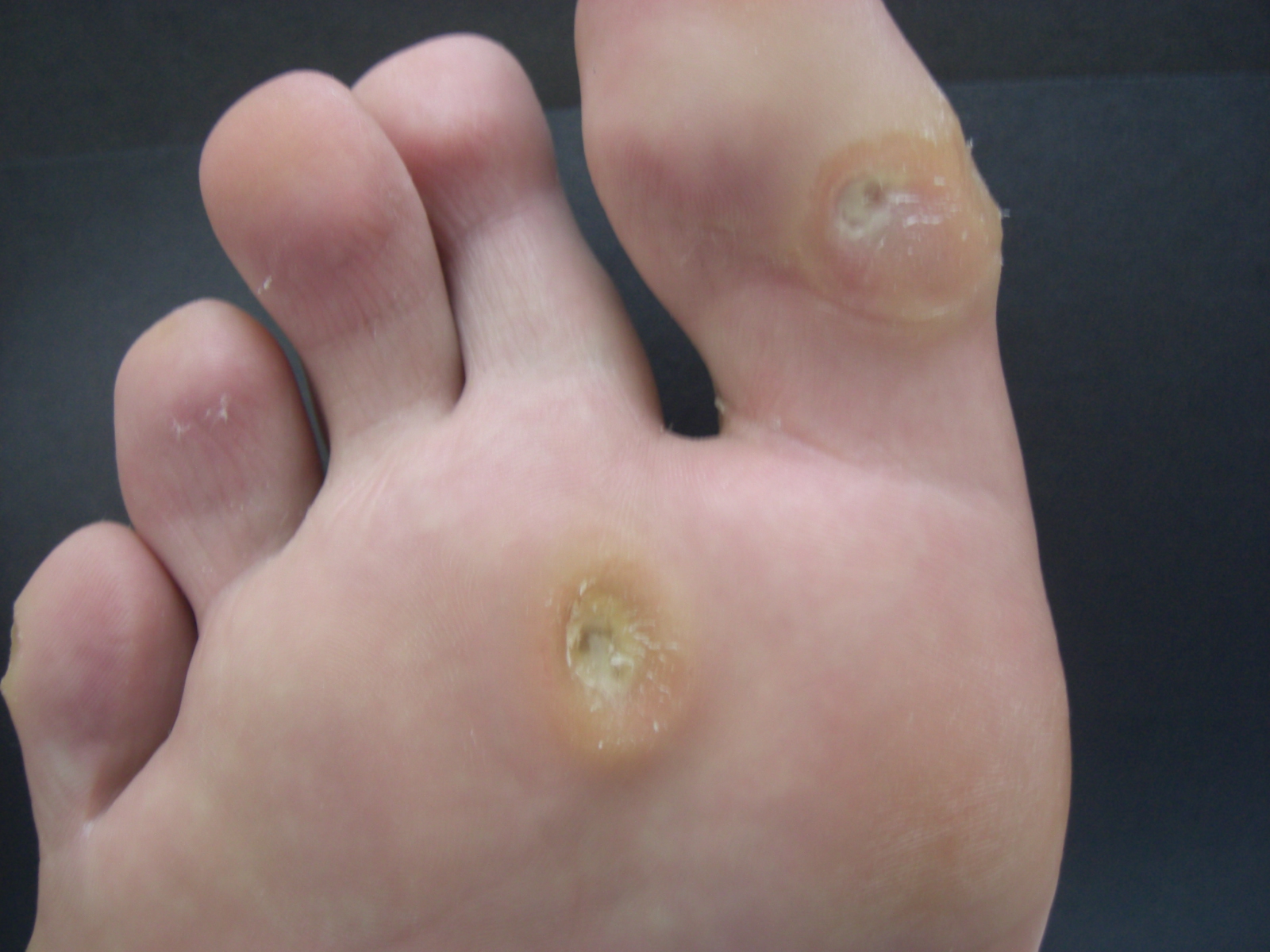 Foot planters wart, large painful callus on big toe, scholl wart