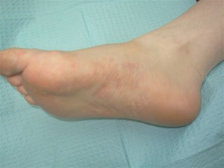 rash on arch of foot