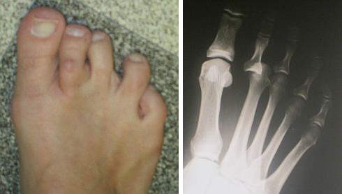 dislocated second toe surgery